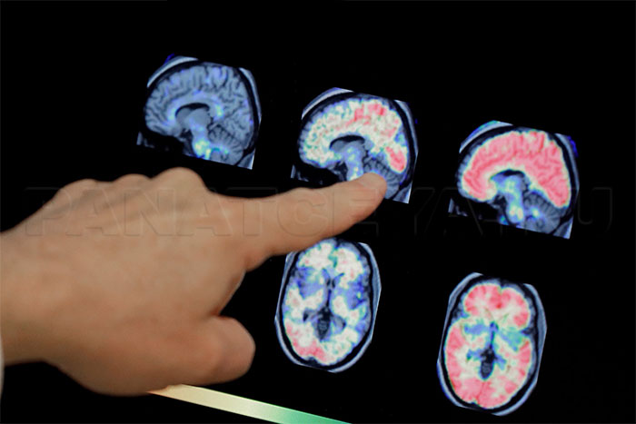 Головной мозг человека, страдающего болезнью Альцгеймера